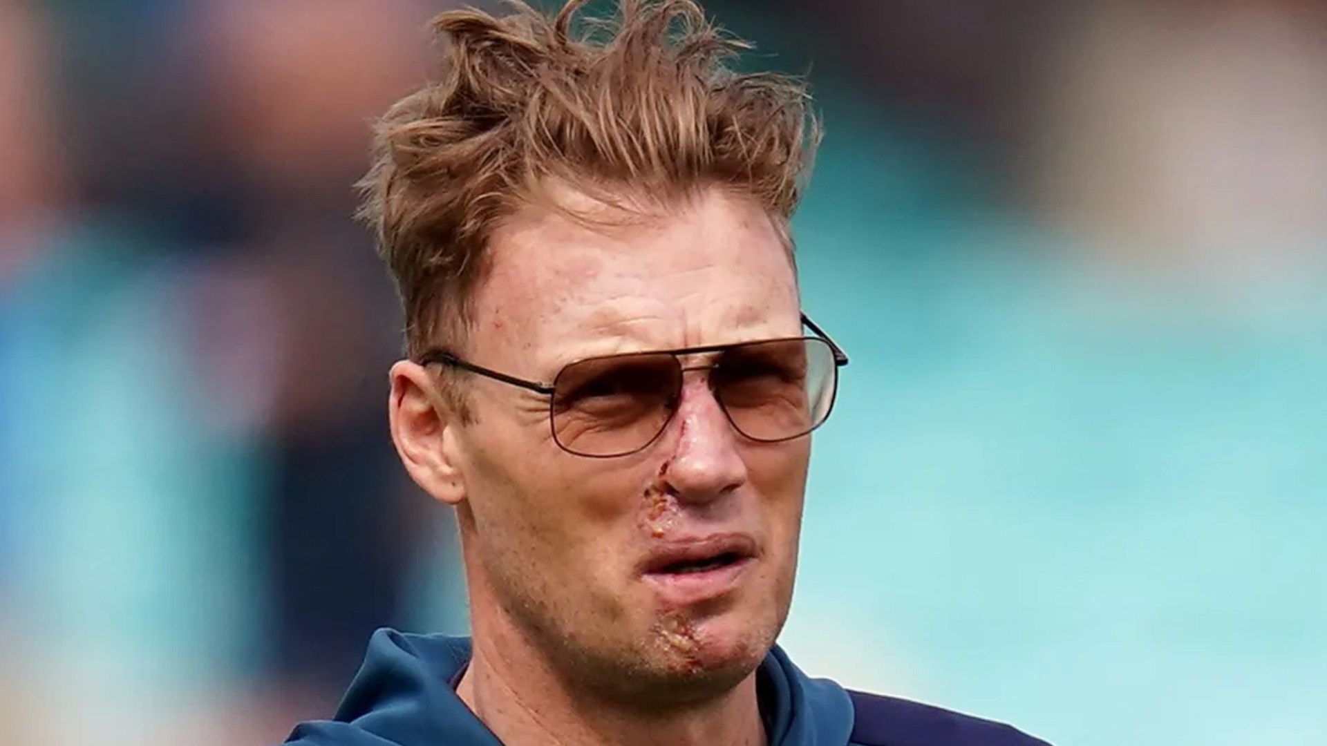 Freddie Flintoff's Face After Top Gear Crash: Update And Recovery Freddie Flintoff's Face After Top Gear Crash: Update And Recovery
