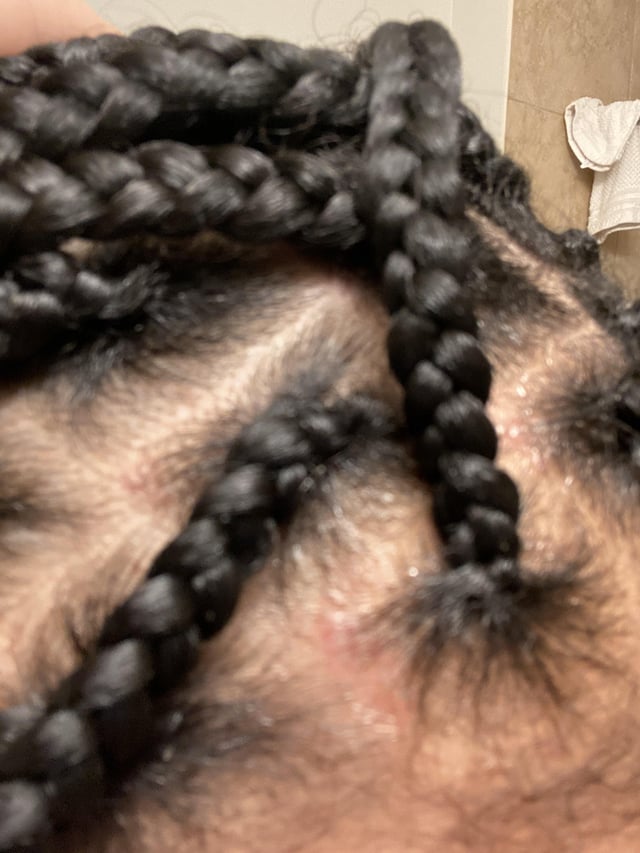 Investigating The Health Risks Associated With Synthetic Hair Braids In Black Women