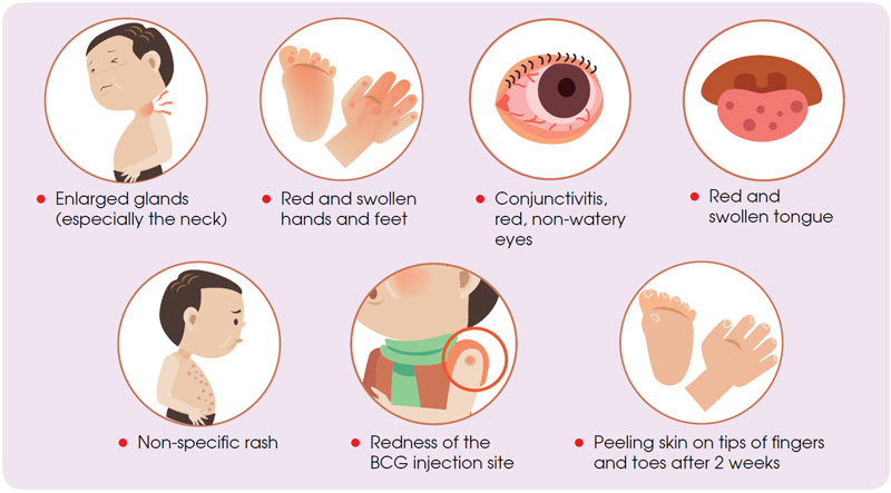 Is A Single, Unknown Respiratory Virus The Cause Of Kawasaki Disease? New Data Suggests A Link Is A Single, Unknown Respiratory Virus The Cause Of Kawasaki Disease? New Data Suggests A Link