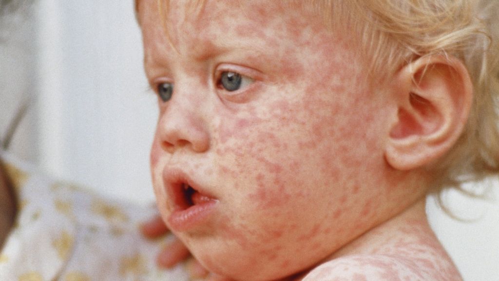 Measles In Kansas: Causes, Prevention, And Current Situation Measles In Kansas: Causes, Prevention, And Current Situation