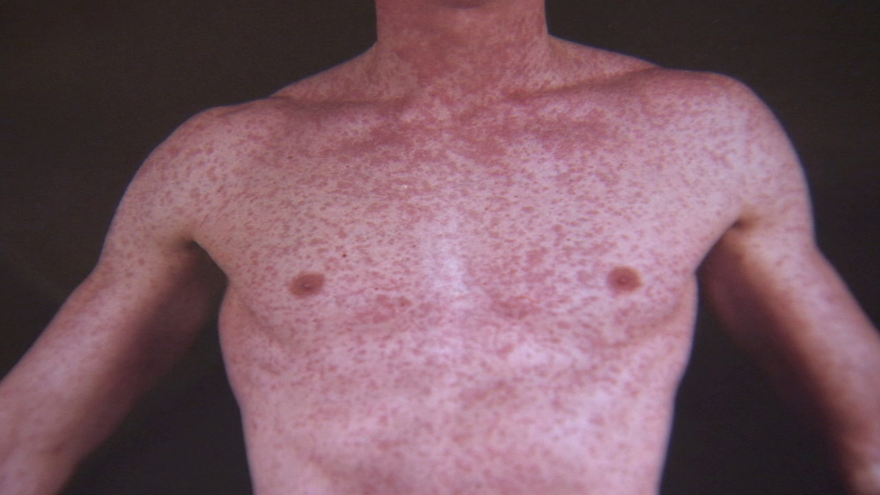 Measles Outbreak Expands: Six More Cases Reported In Kansas Measles Outbreak Expands: Six More Cases Reported In Kansas