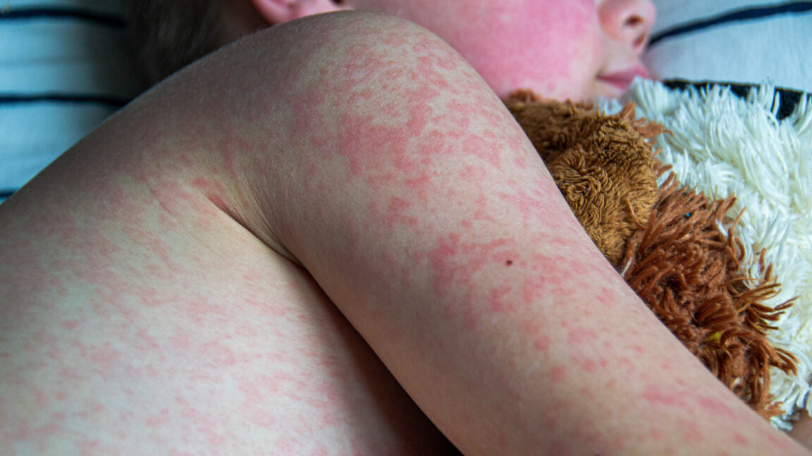 Measles Outbreak In Kansas: A Growing Concern Measles Outbreak In Kansas: A Growing Concern
