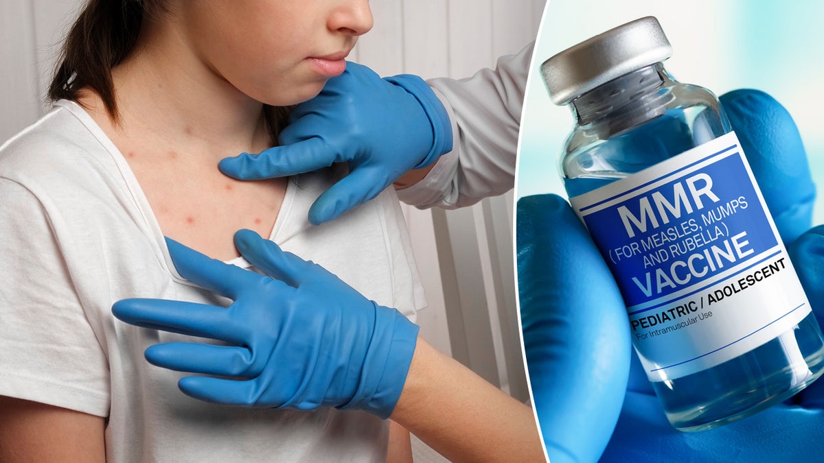 Measles Outbreak Updates: Current Spread In The U.S. Measles Outbreak Updates: Current Spread In The U.S.