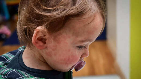 The Persistence Of Measles: Understanding Continued Transmission The Persistence Of Measles: Understanding Continued Transmission