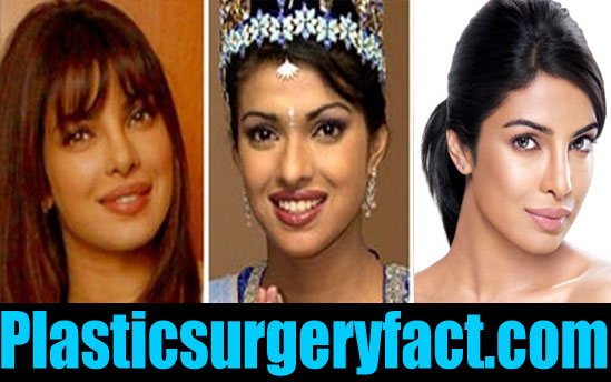The Truth About Priyanka Chopra's Nose Surgery And Her Father's Reaction The Truth About Priyanka Chopra's Nose Surgery And Her Father's Reaction