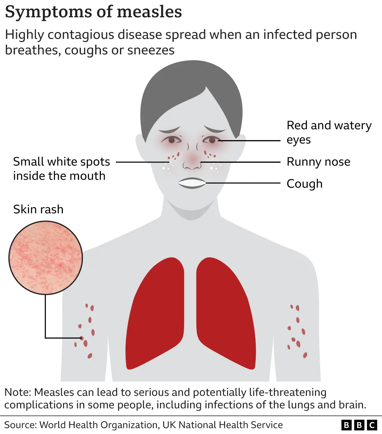 US Measles Cases Rise To 1,046: Indiana Outbreak Concludes US Measles Cases Rise To 1,046: Indiana Outbreak Concludes